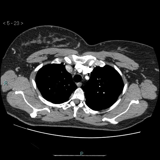 Bronchogenic cyst - posterior mediastinal (Radiopaedia 43885-47364 A 13).jpg