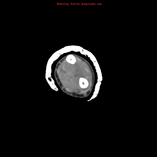 Brown tumor (Radiopaedia 12460-12694 Axial non-contrast 64).jpg