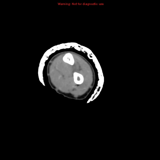 Brown tumor (Radiopaedia 12460-12694 Axial non-contrast 93).jpg
