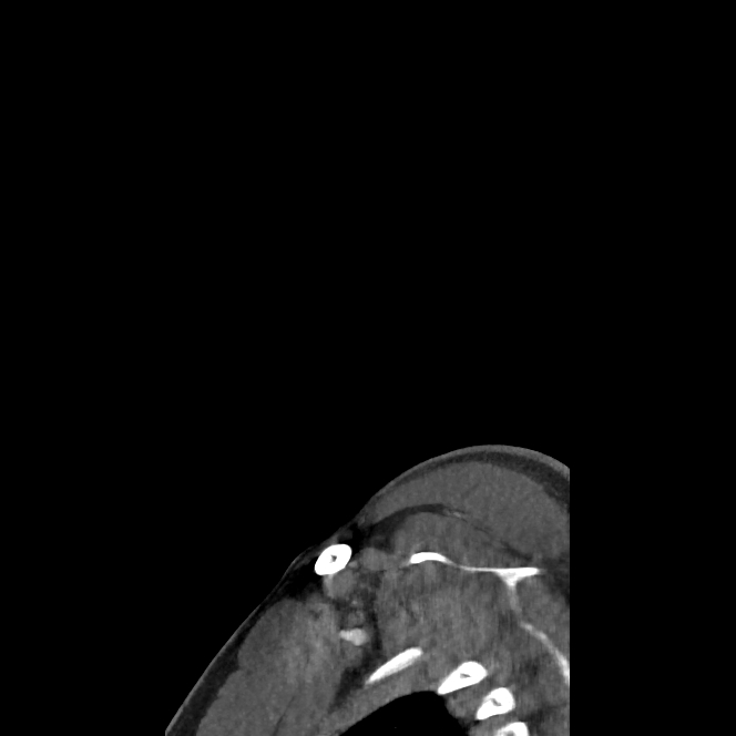 Buccal fat pad arteriovenous malformation (Radiopaedia 70936-81144 C 11).jpg