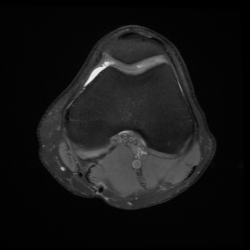 File:Bucket-handle meniscus tear (Radiopaedia 65700-74809 Axial PD fat sat 13).jpg