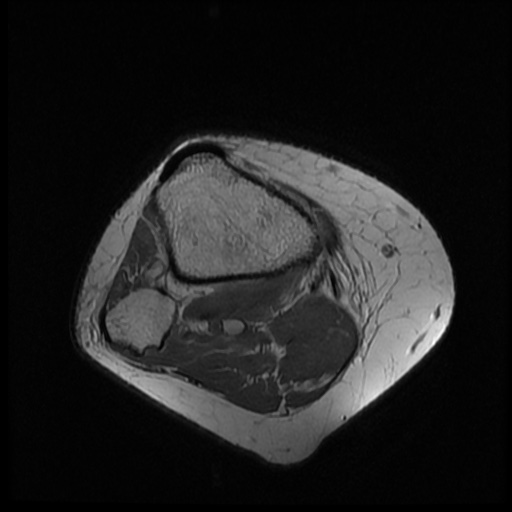 File:Bucket handle meniscus tear (Radiopaedia 56916-63751 Axial PD 20).jpg