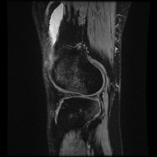 Bucket handle meniscus tear (Radiopaedia 56916-63751 H 15).jpg