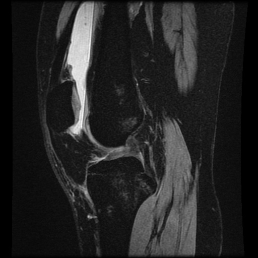 File:Bucket handle meniscus tear (Radiopaedia 56916-63751 H 45).jpg