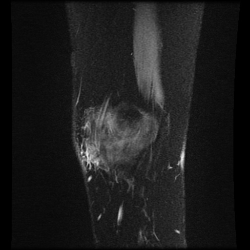 File:Bucket handle meniscus tear (Radiopaedia 56916-63751 H 80).jpg