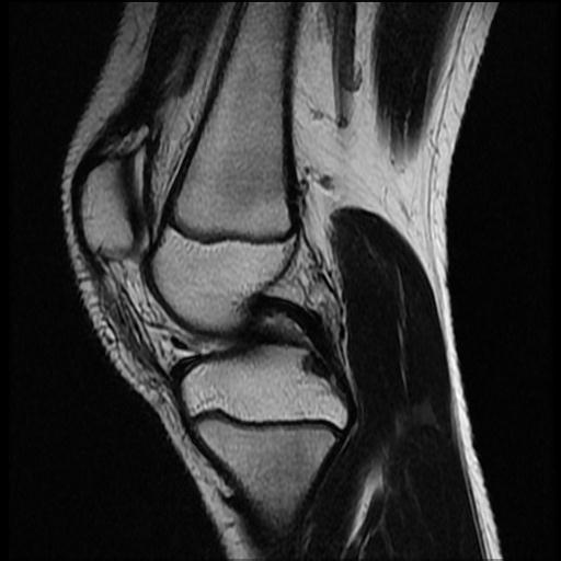 File:Bucket handle tear - lateral meniscus (Radiopaedia 72124-82634 Sagittal T2 10).jpg