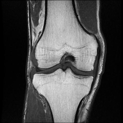 File:Bucket handle tear - medial meniscus (Radiopaedia 69245-79026 Coronal T1 11).jpg