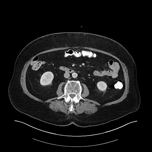 Buried bumper syndrome - gastrostomy tube (Radiopaedia 63843-72575 A 43).jpg
