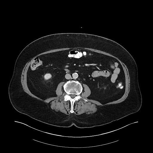 File:Buried bumper syndrome - gastrostomy tube (Radiopaedia 63843-72575 A 47).jpg