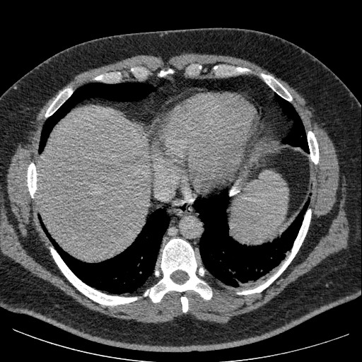 Burned-out testicular seminoma - retroperitoneal nodal metastases (Radiopaedia 62872-71245 A 8).jpg