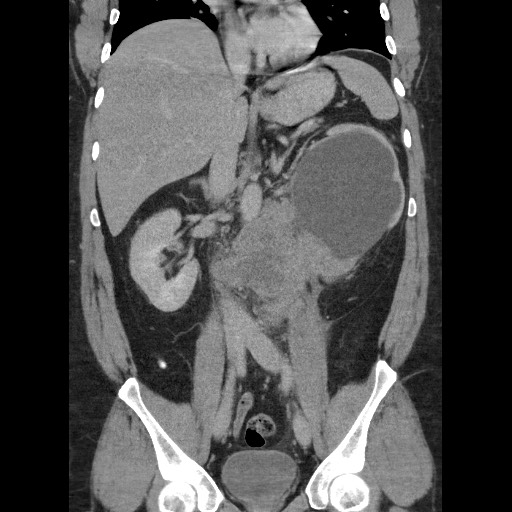 File:Burned-out testicular seminoma - retroperitoneal nodal metastases (Radiopaedia 62872-71245 B 37).jpg