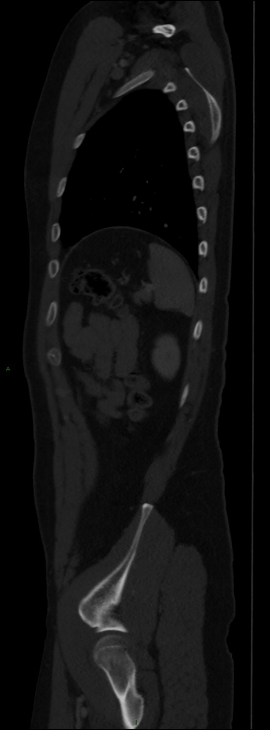 Burst fracture (Radiopaedia 83168-97542 Sagittal bone window 99).jpg