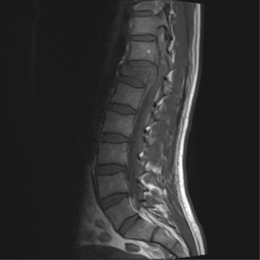 File:Burst fracture - T12 with conus compression (Radiopaedia 56825-63646 Sagittal T1 7).png