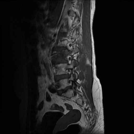 File:Burst fracture - lumbar spine (Radiopaedia 72877-83541 Sagittal T1 9).jpg