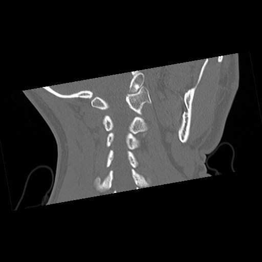 C1-C2 "subluxation" - normal cervical anatomy at maximum head rotation (Radiopaedia 42483-45607 Coronal non-contrast 39).jpg