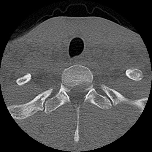 File:C5 facet fracture (Radiopaedia 58374-65499 Axial bone window 86).jpg