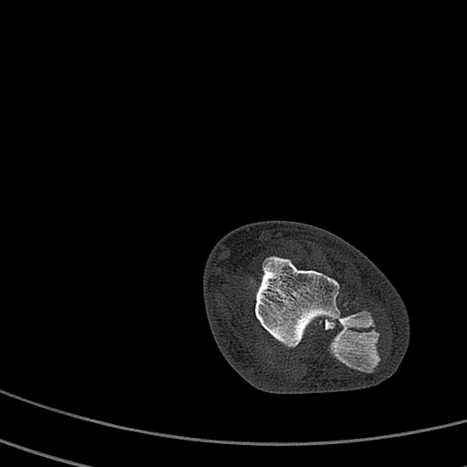 Calcaneal fracture - Sanders type 4 (Radiopaedia 90179-107370 Axial bone window 27).jpg