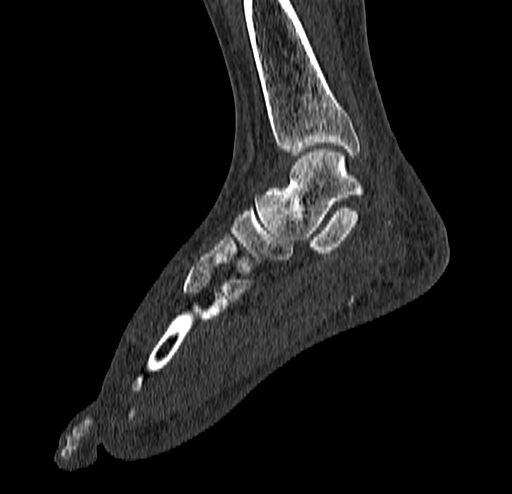 Calcaneal fracture - Sanders type 4 (Radiopaedia 90179-107370 Sagittal bone window 43).jpg