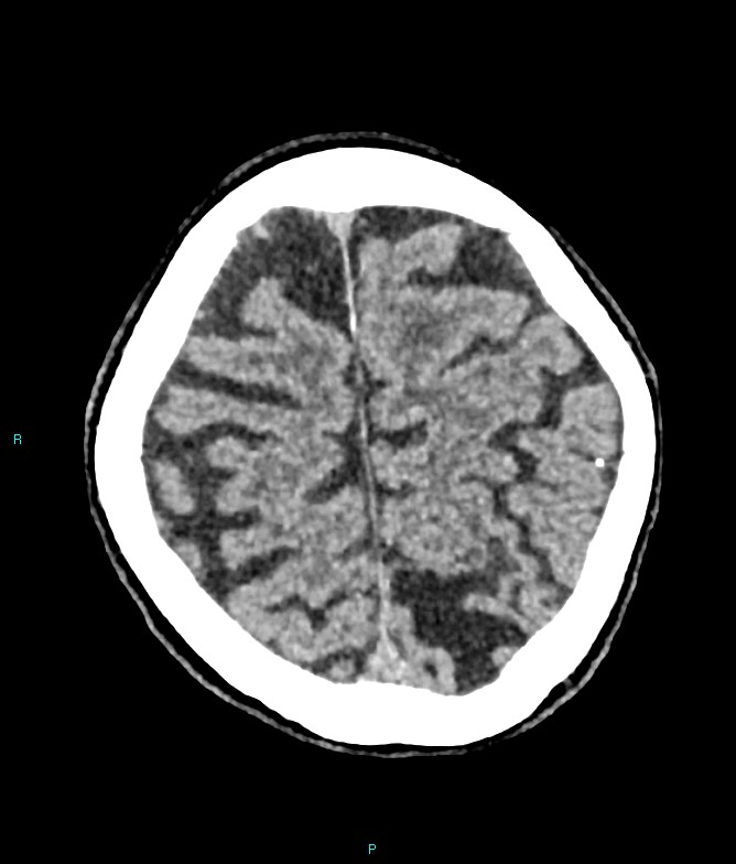 Calcified cerebral emboli from left ventricular thrombus (Radiopaedia 84420-99758 Axial non-contrast 21).jpg