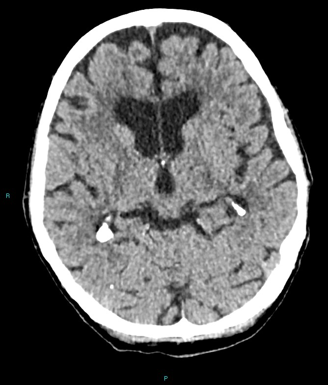 Calcified cerebral emboli from left ventricular thrombus (Radiopaedia 84420-99758 Axial non-contrast 53).jpg
