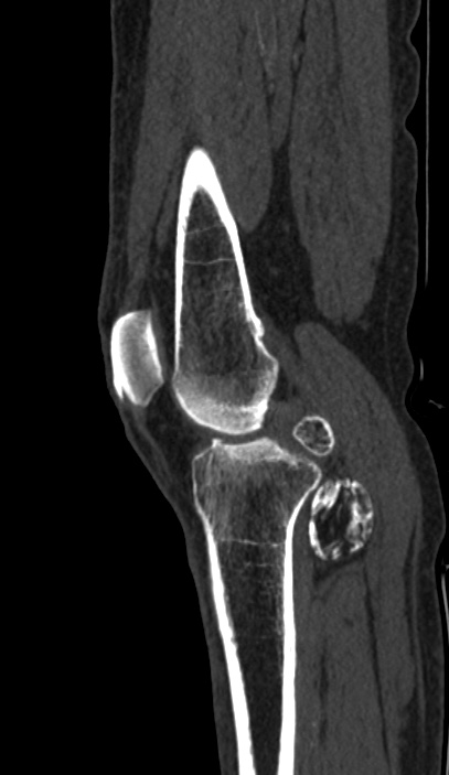 Calcified hematoma - popliteal fossa (Radiopaedia 63938-72763 Sagittal bone window 20).jpg