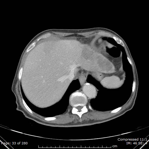 Calcified liver metastases (Radiopaedia 44699-48470 B 12).jpg