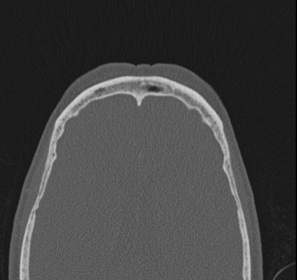 Caldwell-Luc operation (Radiopaedia 52329-58225 Axial bone window 10).jpg