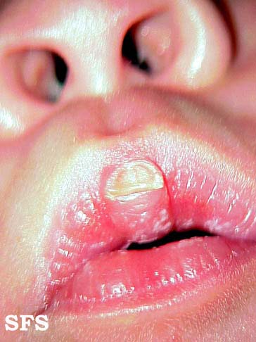 Callosities Of The Lips (Dermatology Atlas 1).jpg