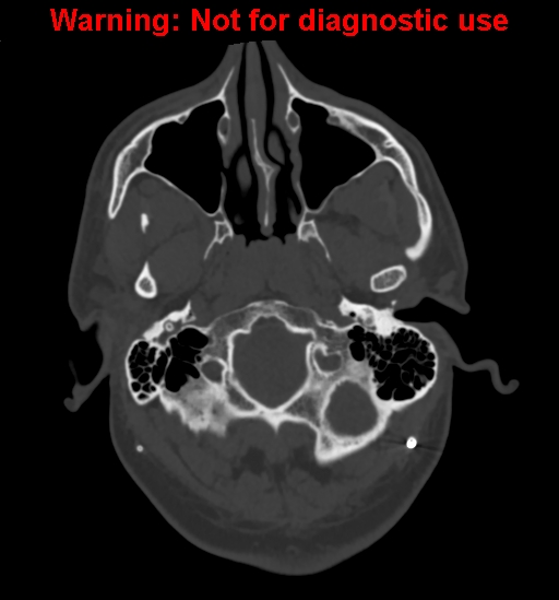 Calvarial thickening from chronic shunting (Radiopaedia 60079-67637 Axial bone window 17).jpg