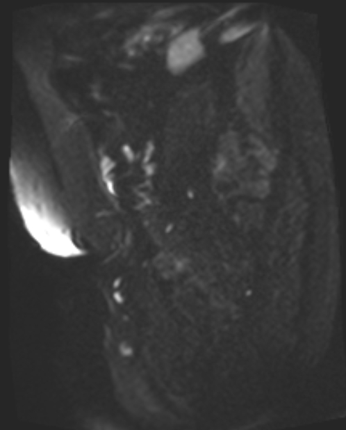 Cancer cervix - stage IIb (Radiopaedia 75411-86615 Sagittal DWI 46).jpg