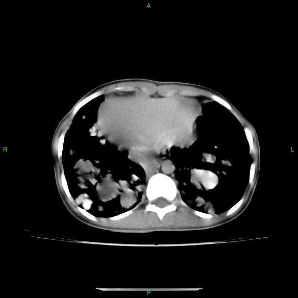 File:Cannon ball metastases - synovial sarcoma (Radiopaedia 26135-26271 C 29).jpg