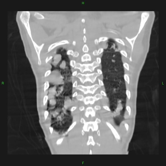 File:Cannon ball metastases - synovial sarcoma (Radiopaedia 26135-26271 Coronal lung window 20).jpg