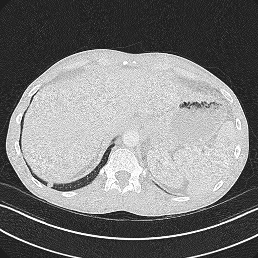 Cannonball metastases - testicular choriocarcinoma (Radiopaedia 84510-99891 Axial lung window 87).jpg