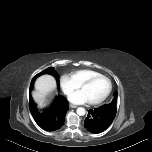 Cannonball metastases from endometrial cancer (Radiopaedia 42003-45031 E 7).png