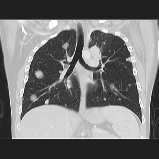 File:Cannonball pulmonary metastases (Radiopaedia 67684-77101 C 13).jpg