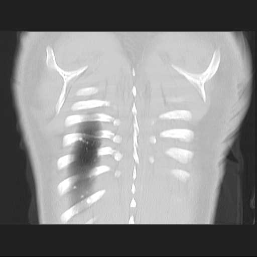 File:Cannonball pulmonary metastases (Radiopaedia 67684-77101 C 24).jpg
