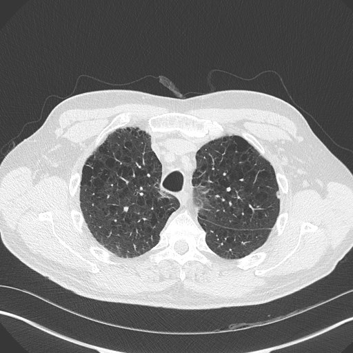 Caplan syndrome (Radiopaedia 56667-63530 Axial lung window 54).jpg