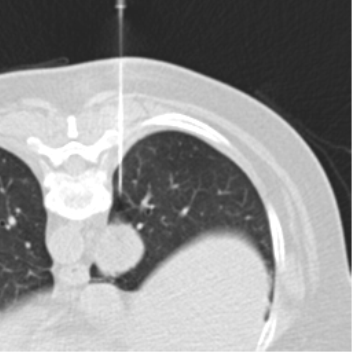 Carcinoid tumor - lung (Radiopaedia 44814-48644 Axial lung window 75).png