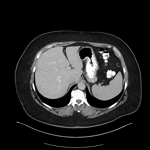 File:Carcinoid tumor - terminal ileum (Radiopaedia 60931-68739 A 28).jpg