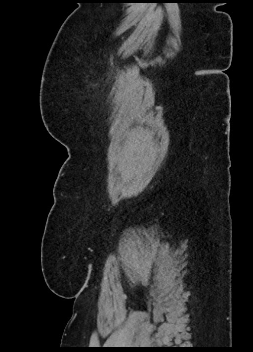 Carcinoid tumor - terminal ileum (Radiopaedia 60931-68739 C 101).jpg