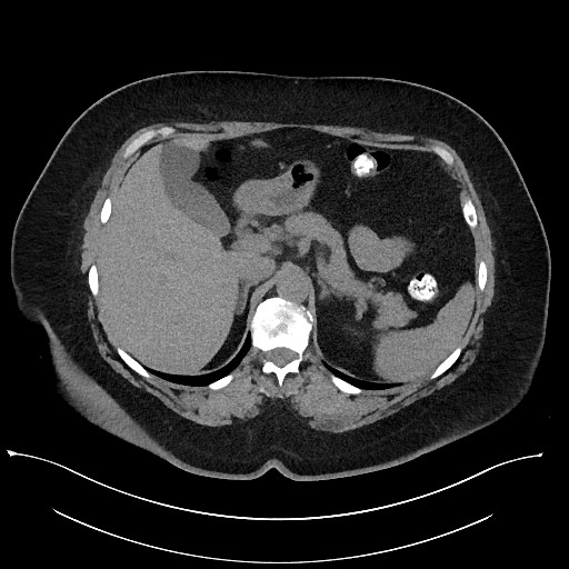 Carcinoid tumor - terminal ileum (Radiopaedia 60931-68740 Axial non-contrast 24).jpg