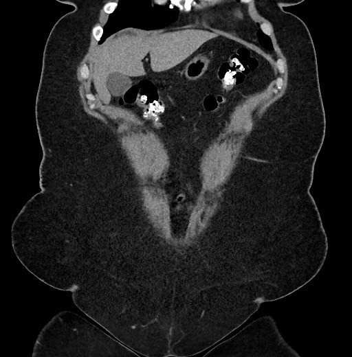 Carcinoid tumor - terminal ileum (Radiopaedia 60931-68740 Coronal non-contrast 14).jpg