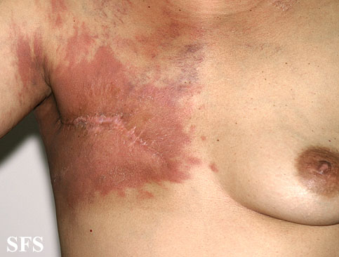 Carcinoma Erysipeloides (Dermatology Atlas 2).jpg