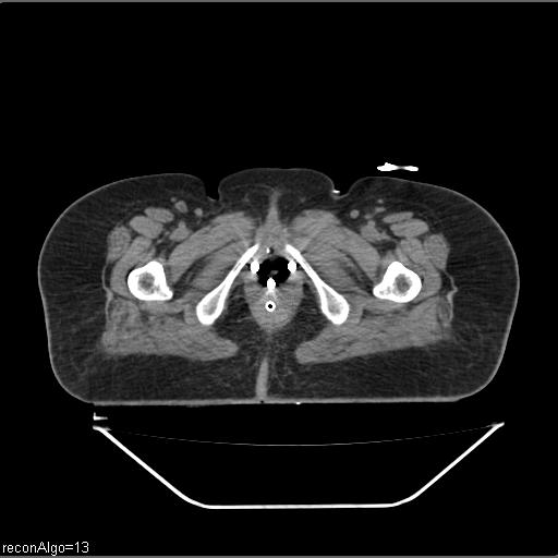 Carcinoma cervix- brachytherapy applicator (Radiopaedia 33135-34173 Axial non-contrast 49).jpg