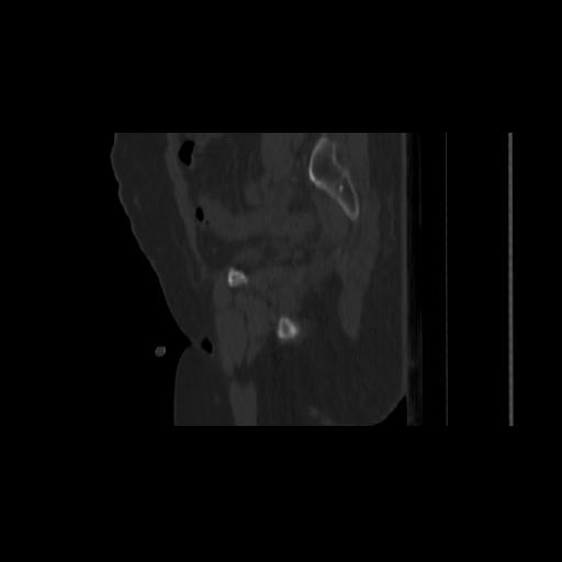 Carcinoma cervix- brachytherapy applicator (Radiopaedia 33135-34173 Sagittal bone window 49).jpg