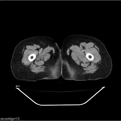 File:Carcinoma cervix- recurrence (Radiopaedia 34702-36137 B 61).jpg