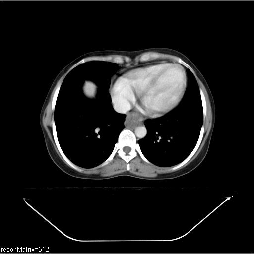 File:Carcinoma of esophagus (Radiopaedia 27356-27550 A 12).jpg