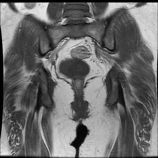 File:Carcinoma of the cervix (Radiopaedia 89018-105858 Coronal T1 12).jpg