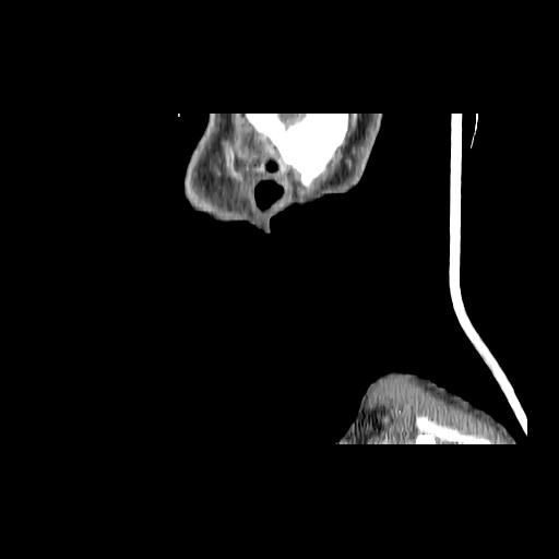 Carcinoma of the maxillary antrum (Radiopaedia 53805-59888 Sagittal C+ delayed 6).jpg