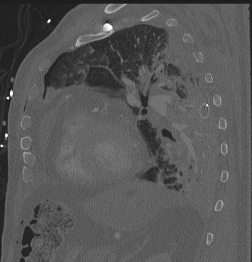 Cardiac trauma (Radiopaedia 32874-33858 Sagittal bone window 2).jpg